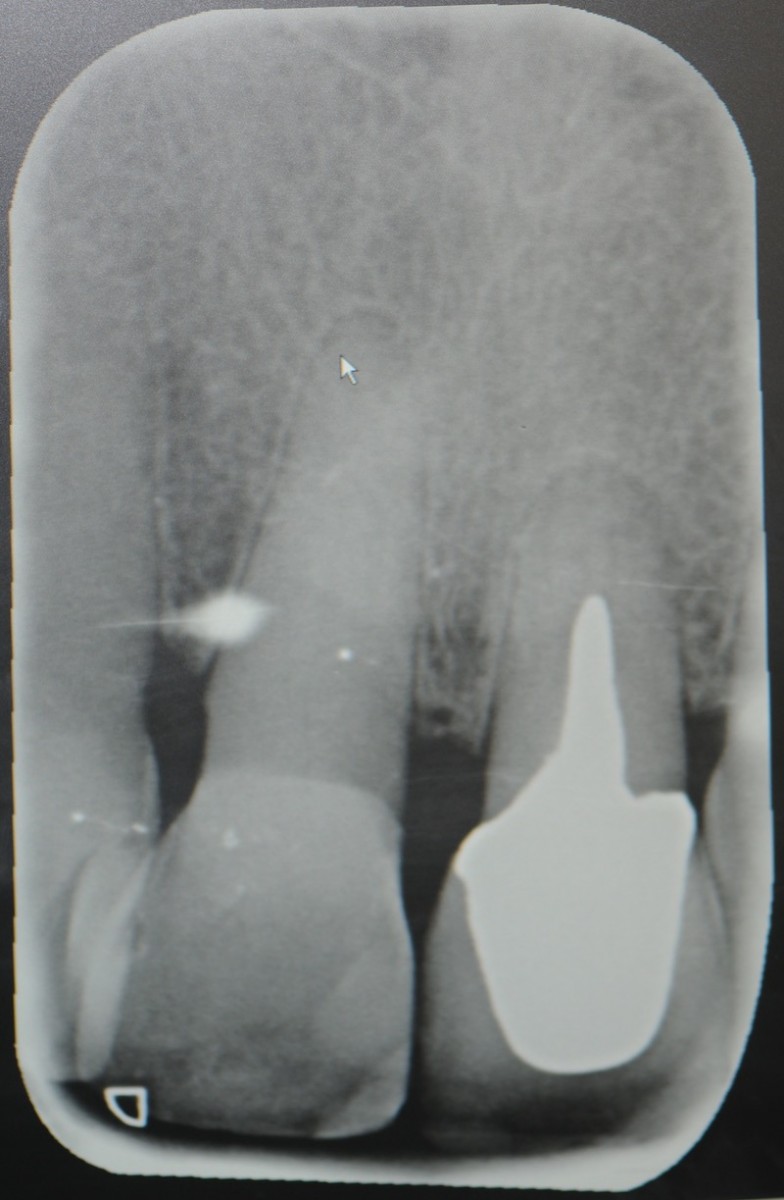 Fig. 2 Initial situation, periapical intraoral radiography, insufficient root size and contraindication of element recovery