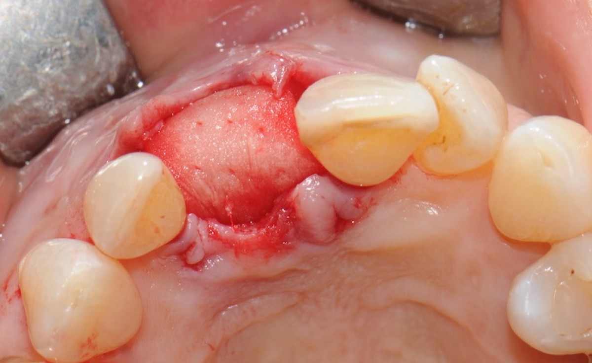 Fig. 5 Post-extraction socket cover using the collagen matrix, adapted to the alveolar morphology and covered, for at least 2/3 of its surface, from the mucous flap, without periosteal incisions