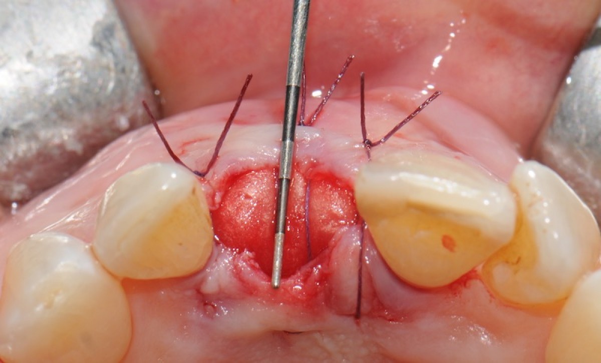 Fig. 6 Stabilization of the mucosal flap and of the matrix through stitches in nylon 5/0. The size of the exposed matrix surface is highlighted