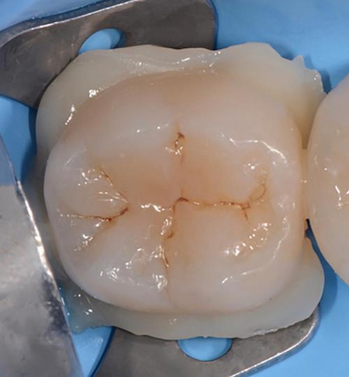 Adhesive or conventional luting for single crown cementation