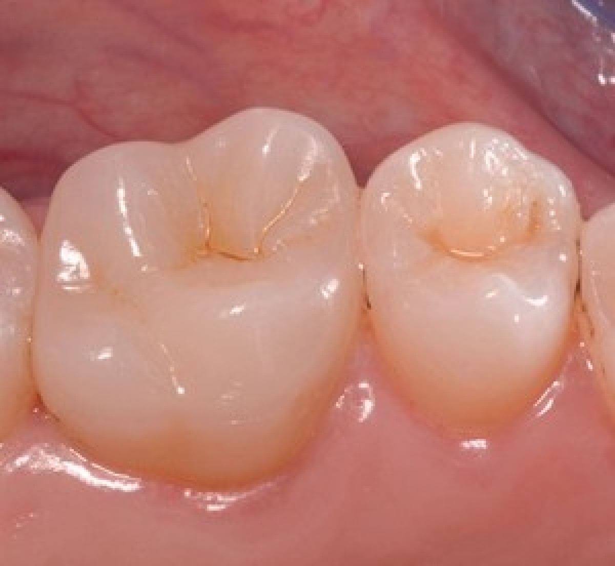 Cementation of zirconia crowns: effectiveness of self-adhesive dual