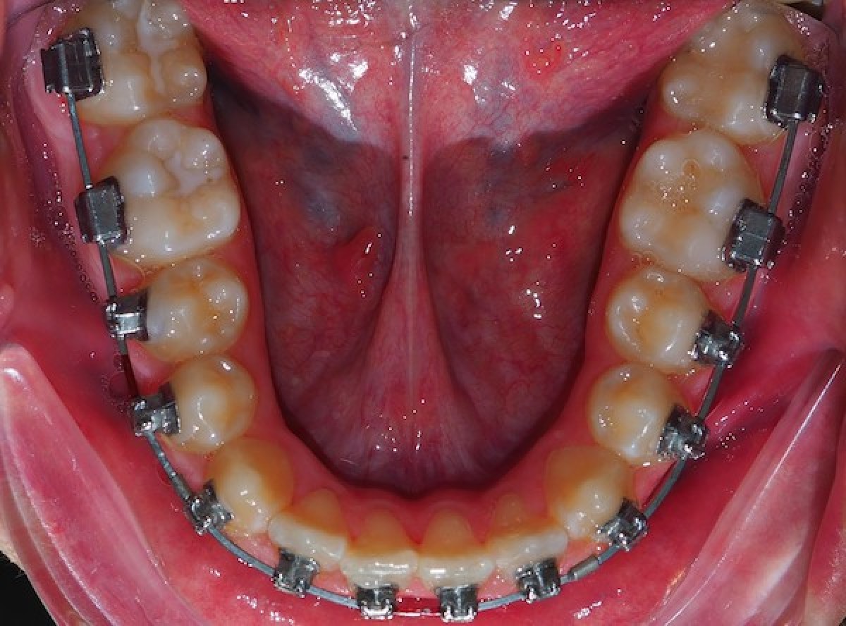 Archwire selection in the orthodontic treatment should we go digital? Dentistry33