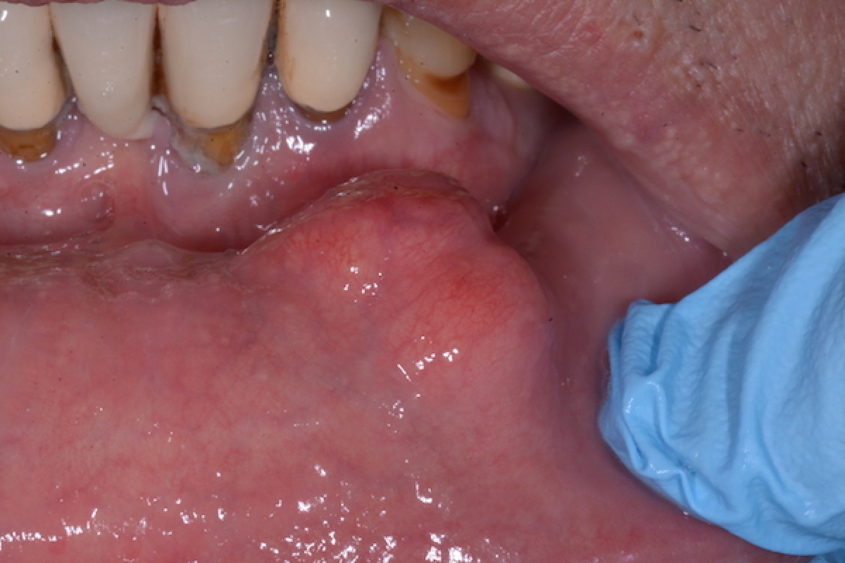 Fig1: intraoral aspect