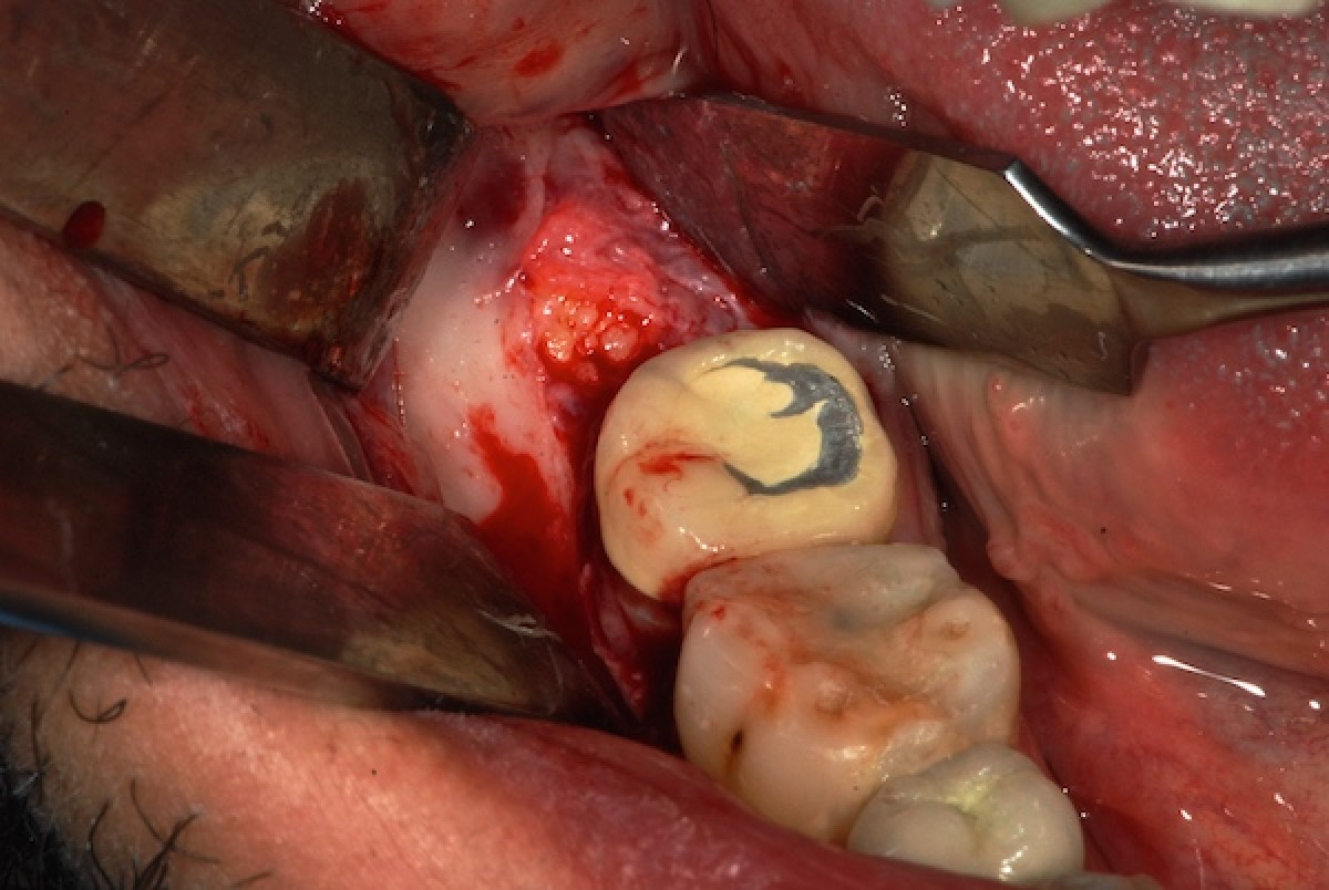 <p>Figure 3: incisional biopsy</p>