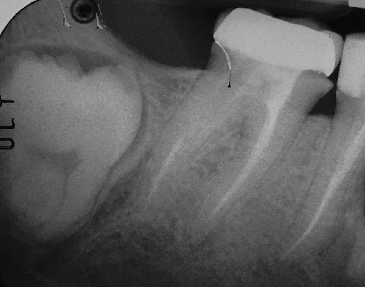 <p>Figure 4: periapical radiography after 6 months</p>