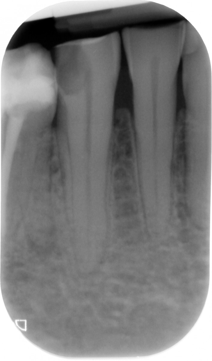 Fig. 1: A pulp disease lead to the endodontic treatment of lower left canine