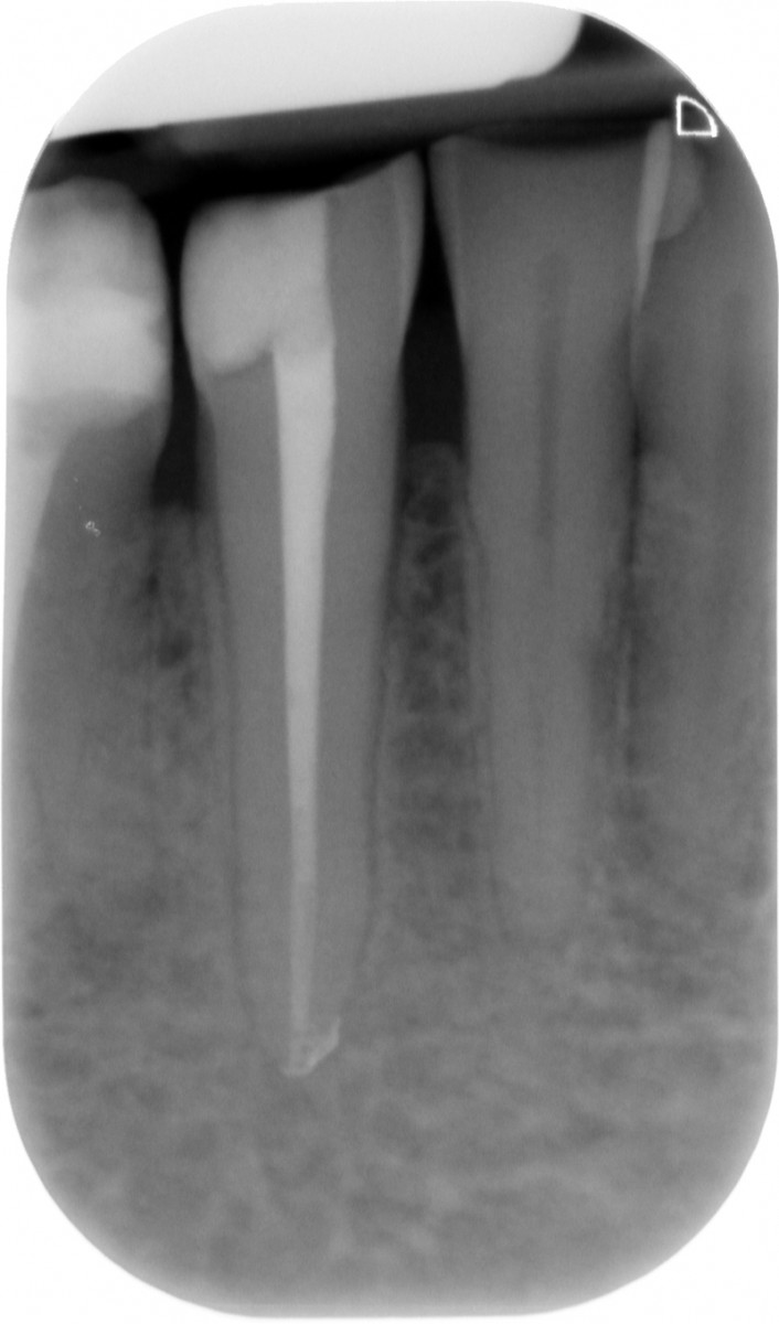 Fig. 2: The complete filling by endodontic bioactive sealer