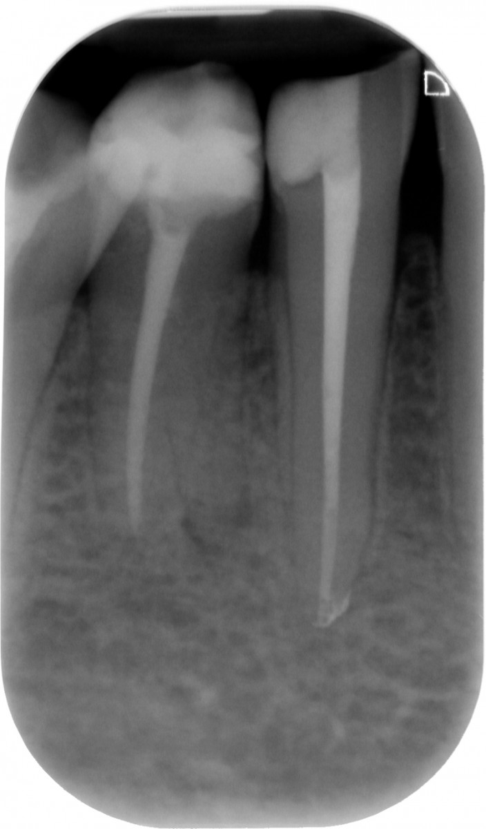 Fig. 3: During a follow up (6 months later) visit a hidden radix was found in adjacent premolar