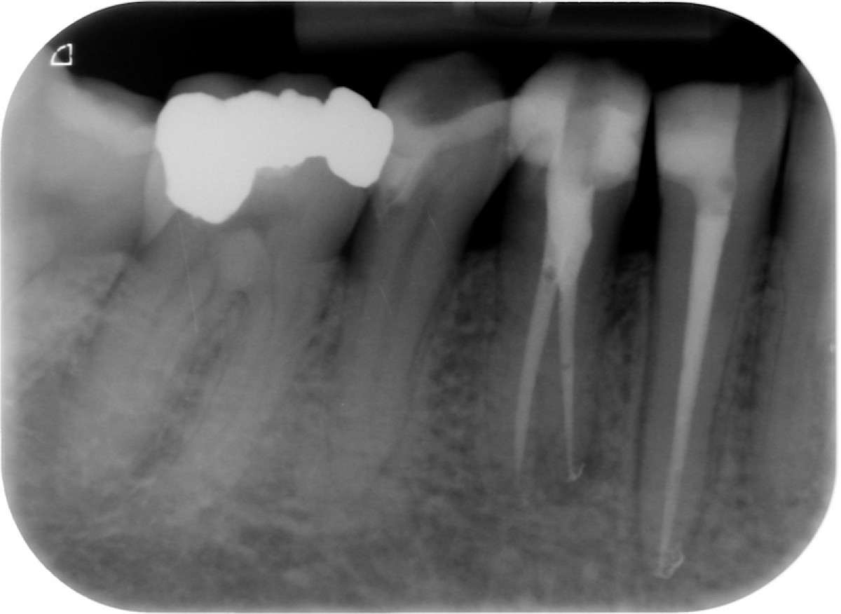 Fig. 4: A new root canal treatment was performed and the root canal was sealed by endodontic bioactive sealer