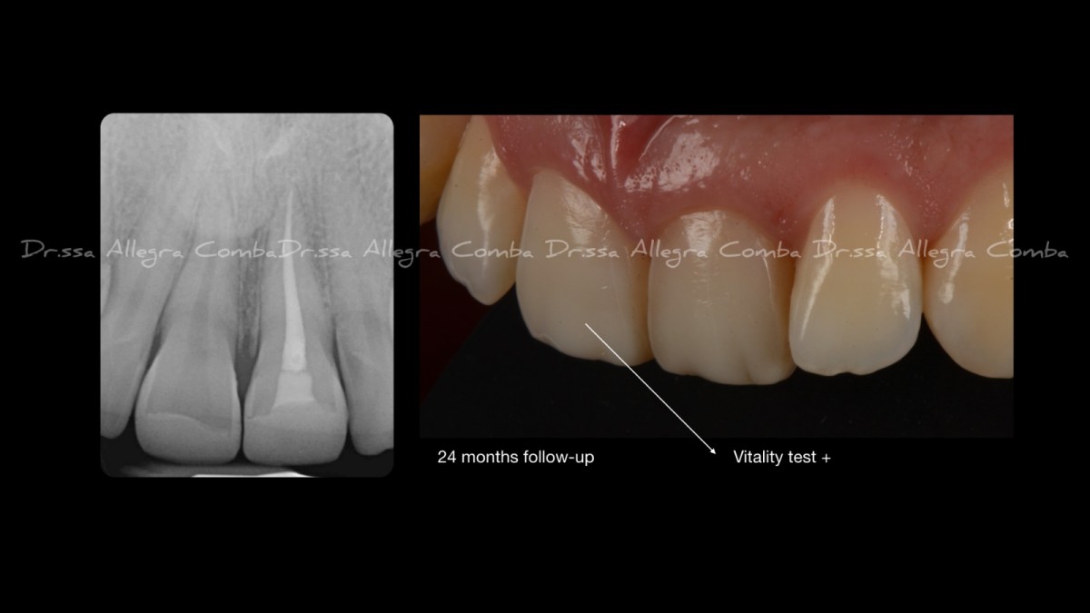 Image 11: Restorative procedures on molars