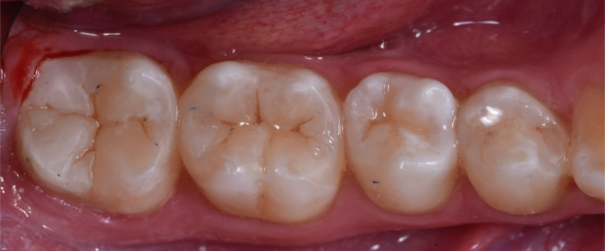 Image 12: Restorative procedures on molars