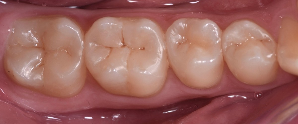 Image 13: Restorative procedures on molars