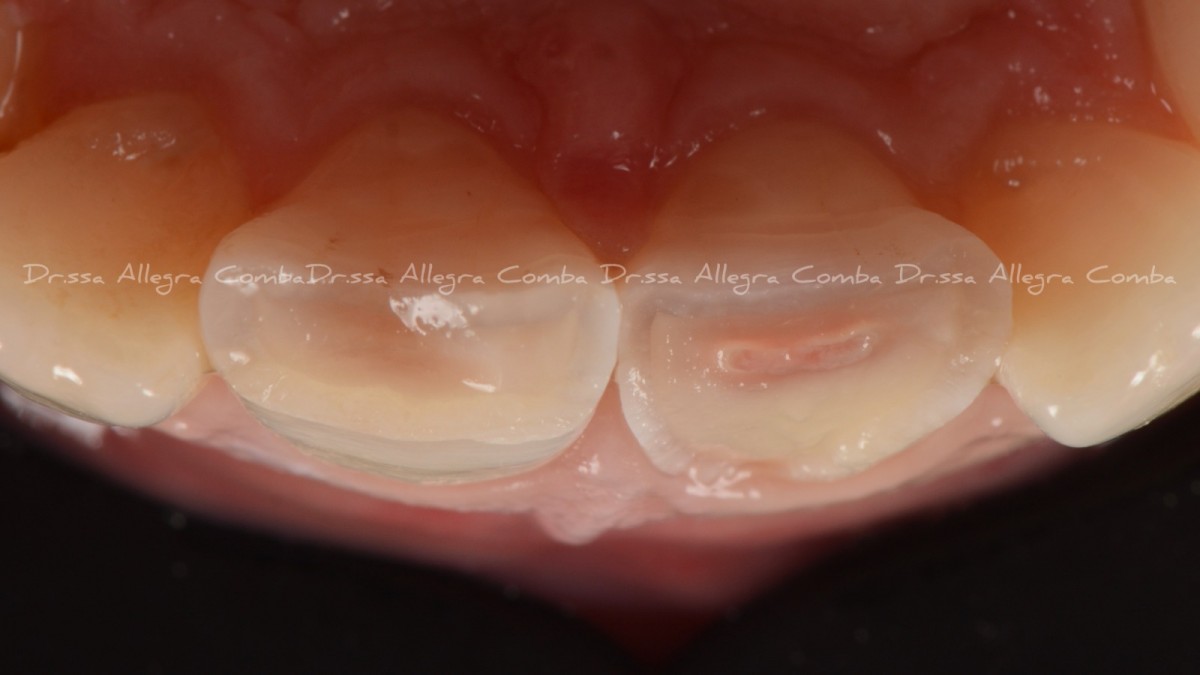 Image 2: Dental field after rubber dam isolation and final cavities after caries removal