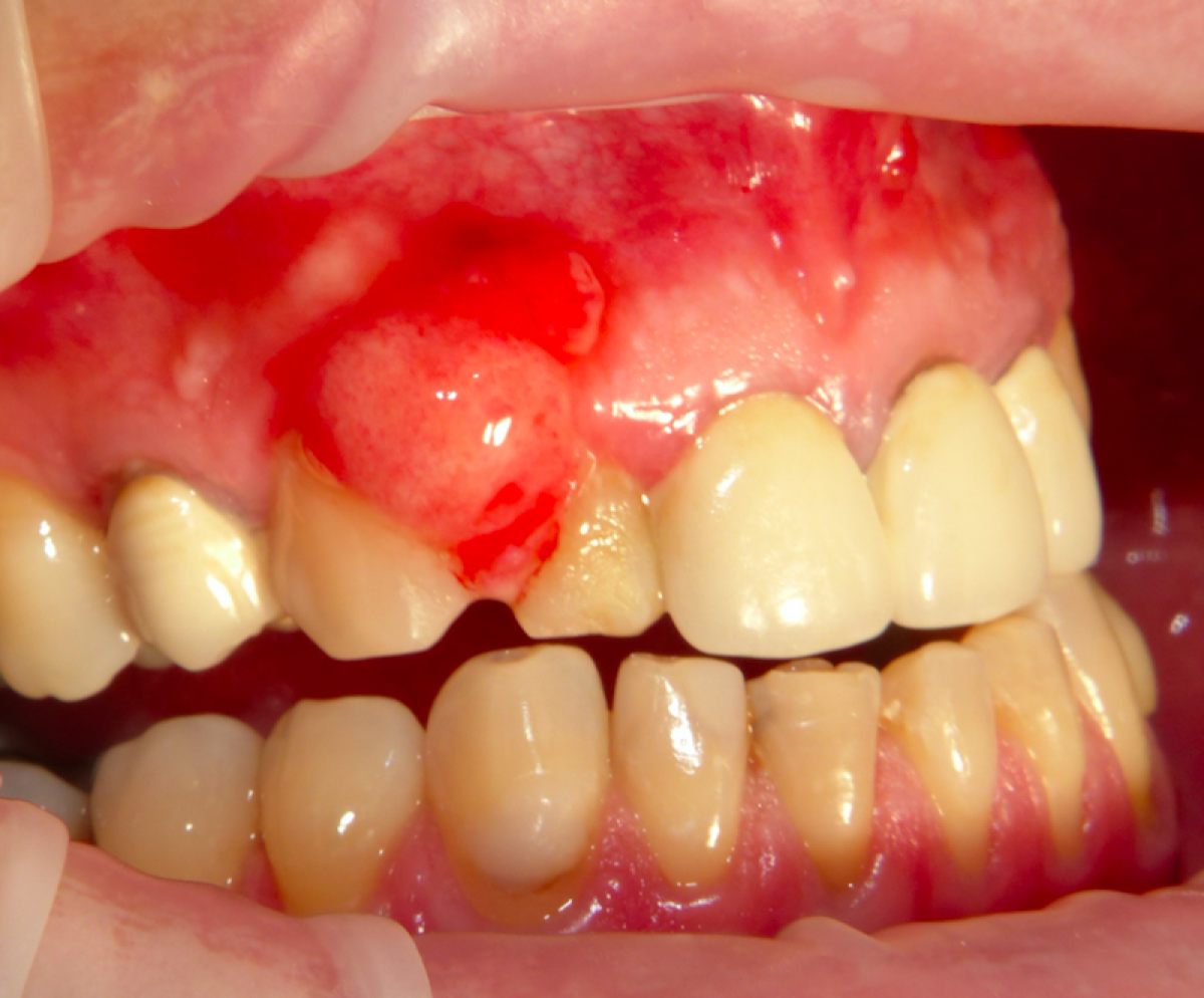 Fig.1 - Evident roundish gingival lesion, on the intraoral objective examination, associated with elements 1.2 and 1.3