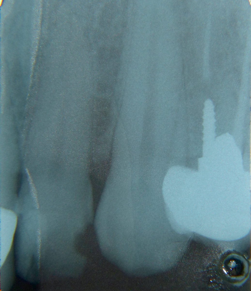 Fig. 2 - The intraoral radiography does not show signs of involvement of the underlying hard tissues to the injury