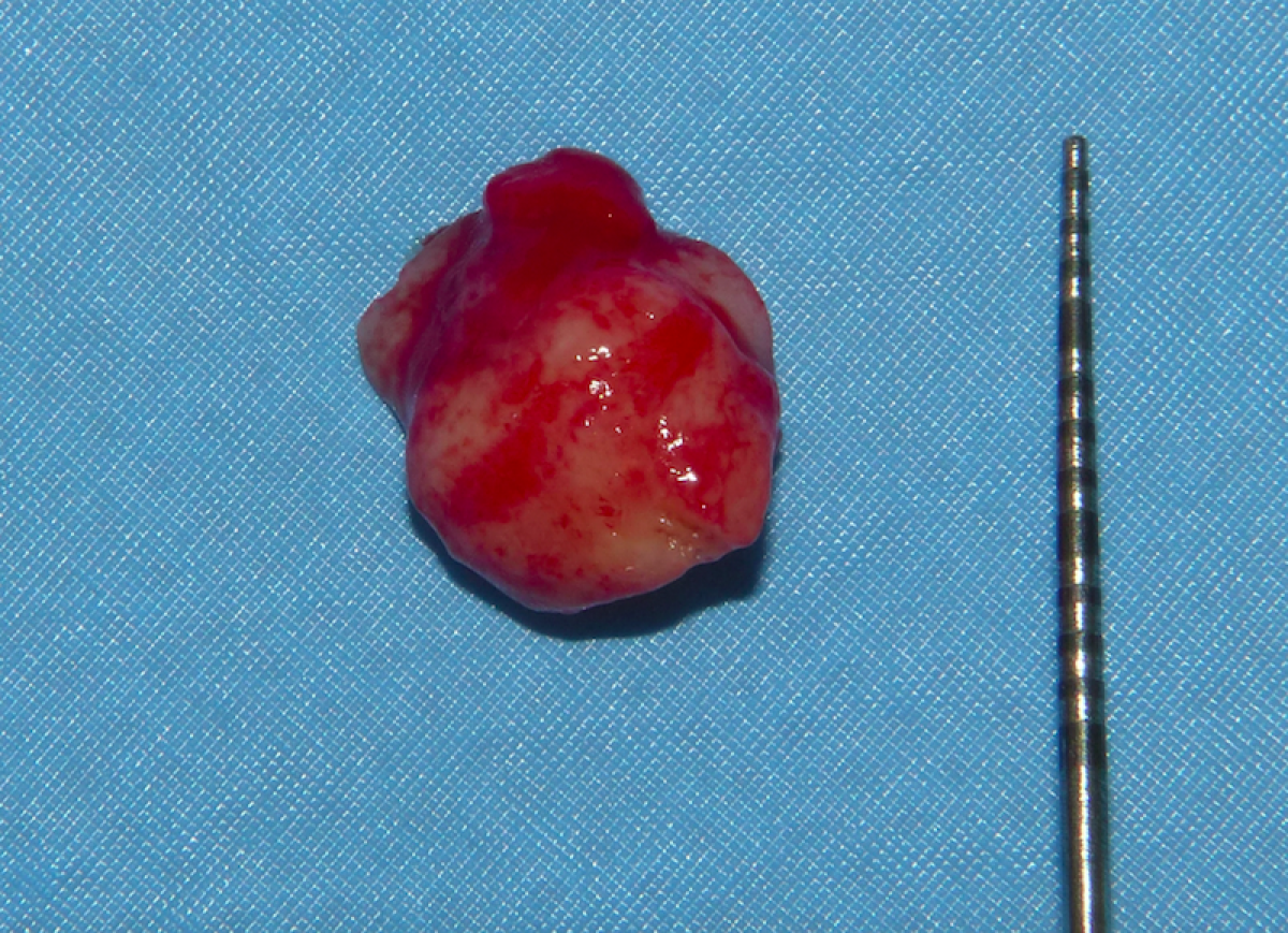 Fig. 3 - The lesion, completely removed, has a size of about 1 cm