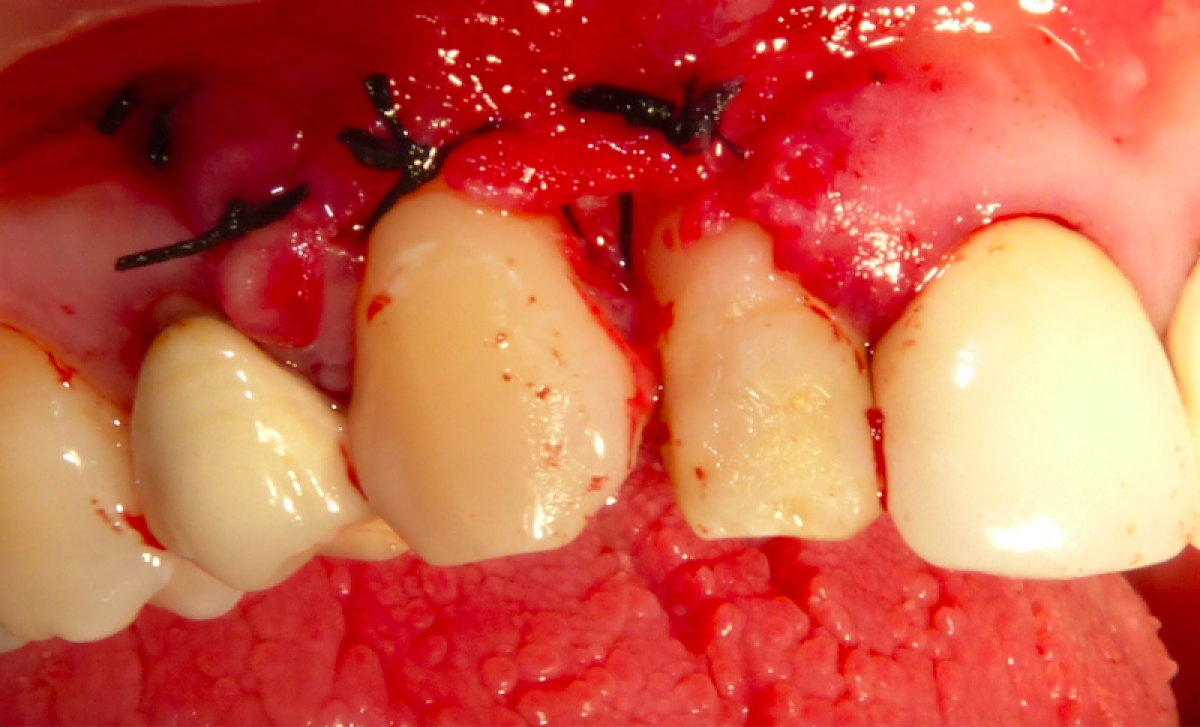 Fig. 4 - Detached stitches. Horizontal cuts were made in the buccal periosteum to mobilize the flap as much as possible and to pull it in a coronal direction so as to leave a minimum amount of bone exposed