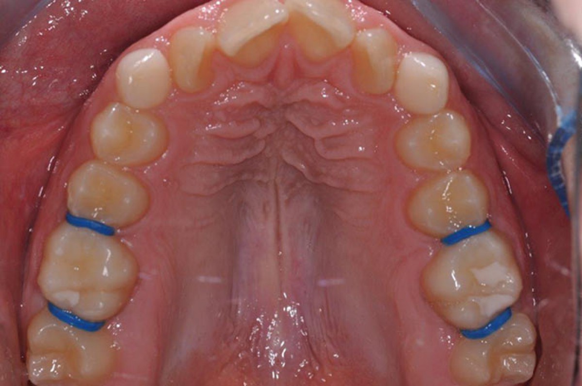 <p>Fig. 5 The palate at the end of the transversal expansion</p>