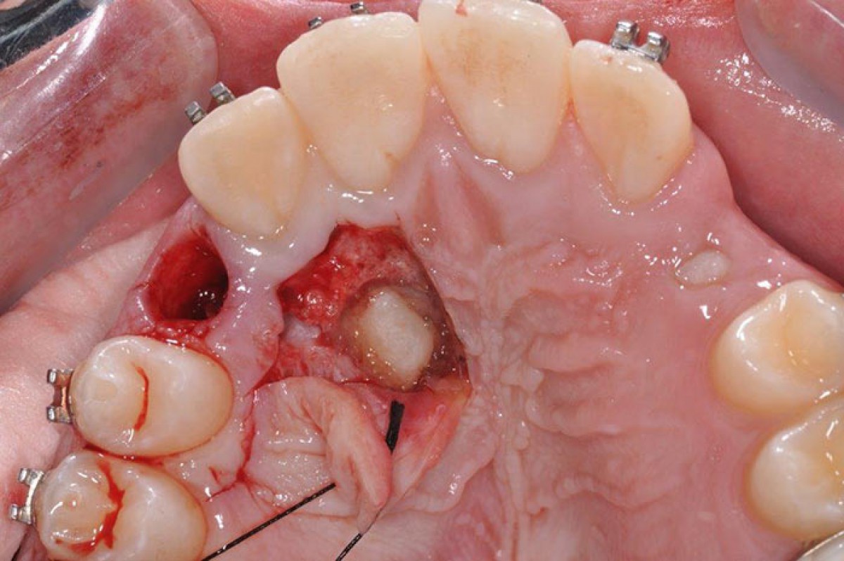 <p>Fig. 6 The display of the canine. Note the festooning of the flap, respecting the periodontal structures of proximal teeth and haemostasis. The tunnel obtained from the extraction of the deciduous element will be used to pull the element included in its natural seat</p>