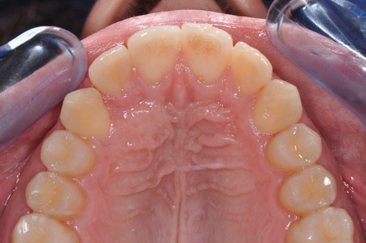 <p>Fig. 10 The case at the end of the treatment</p>