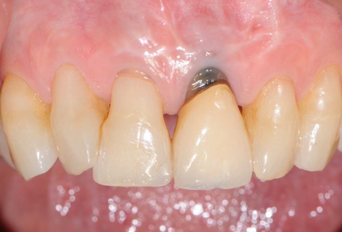 Fig. 1 Initial situation, clinical picture, frontal view. The element 2.1 results seriously compromised. We decided to proceed to its avulsion and then with implant-prosthetic rehabilitation.