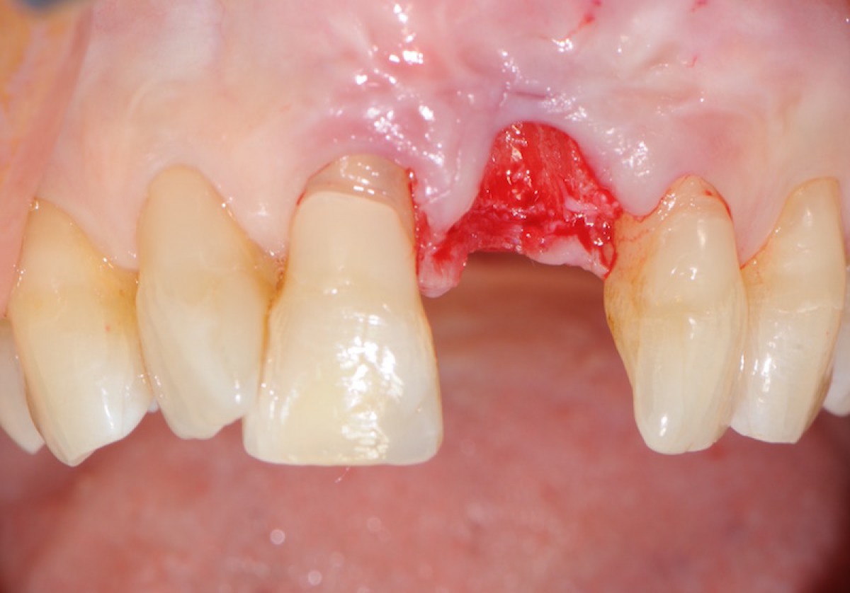 Fig. 3 Post-extractive alveolus; minimally invasive avulsion, frontal vision