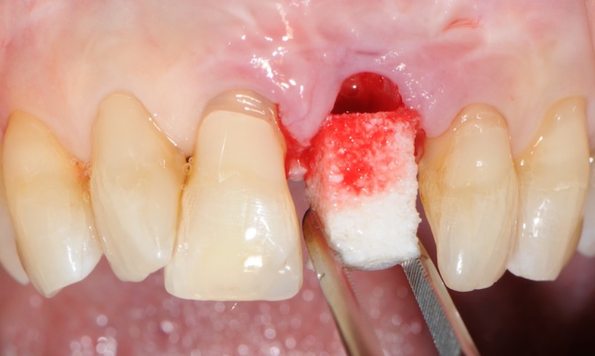 Fig. 4 Biomaterial grafting into the alveolus; it will provide support for soft tissues above