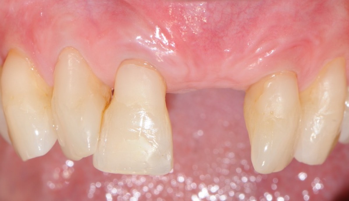 Fig. 7 Clinical check at 8 weeks from the intervention. Front view. In evidence the perfect aesthetic integration of the newly formed keratinized tissue with the surrounding tissue