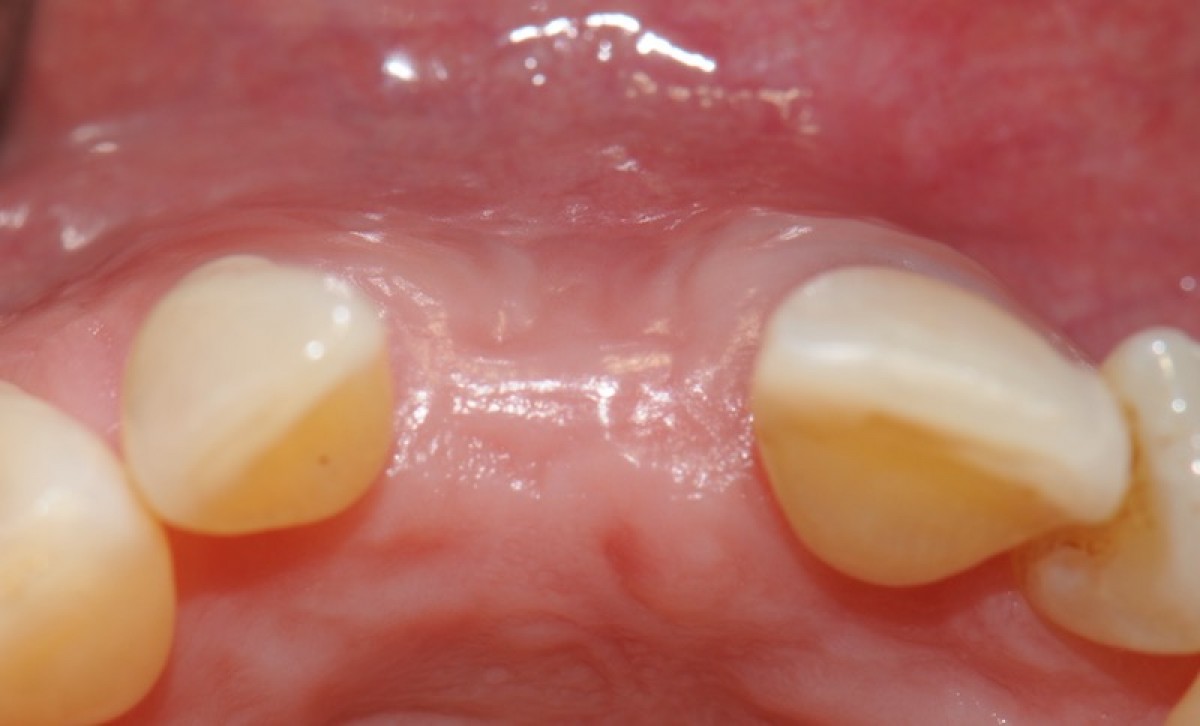 Fig. 8 Clinical check at 8 weeks from the intervention. Occlusal view. The perfect aesthetic integration of the keratinized tissue is highlighted newly formed with the surrounding tissue