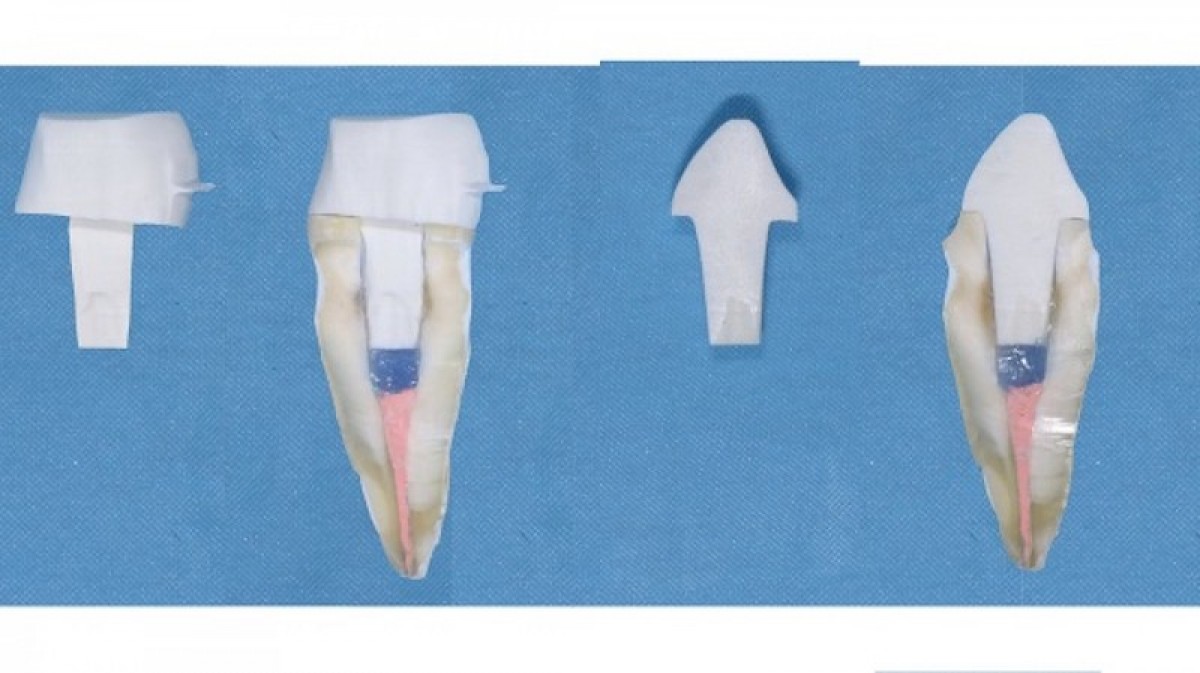 Figure 5: The piece adapted into the ovoid canal.