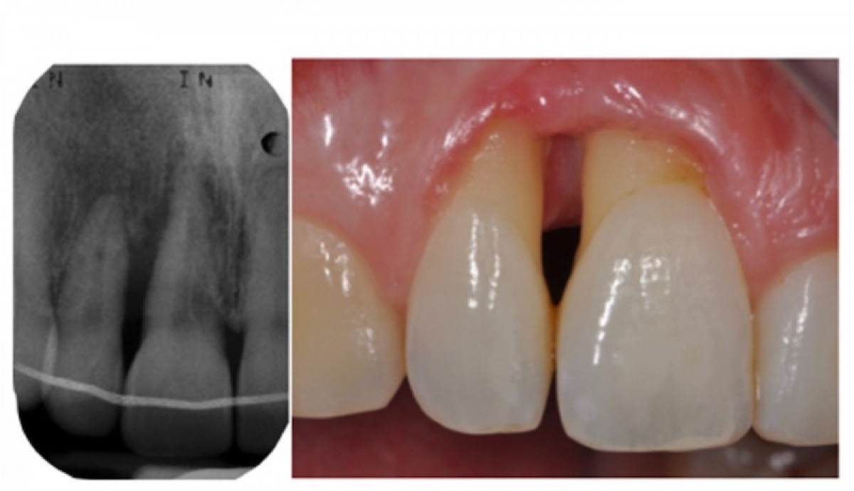 <p>Figure 1: at the beginning of the therapy</p>