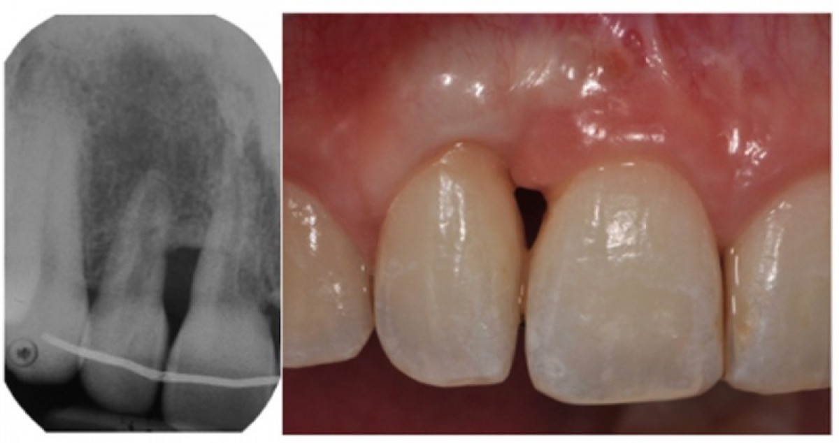 Figure 3: the result at 5 years from the beginning of the treatment.