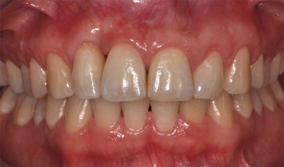 Figure 4: the result at 5 years from the beginning of the treatment.