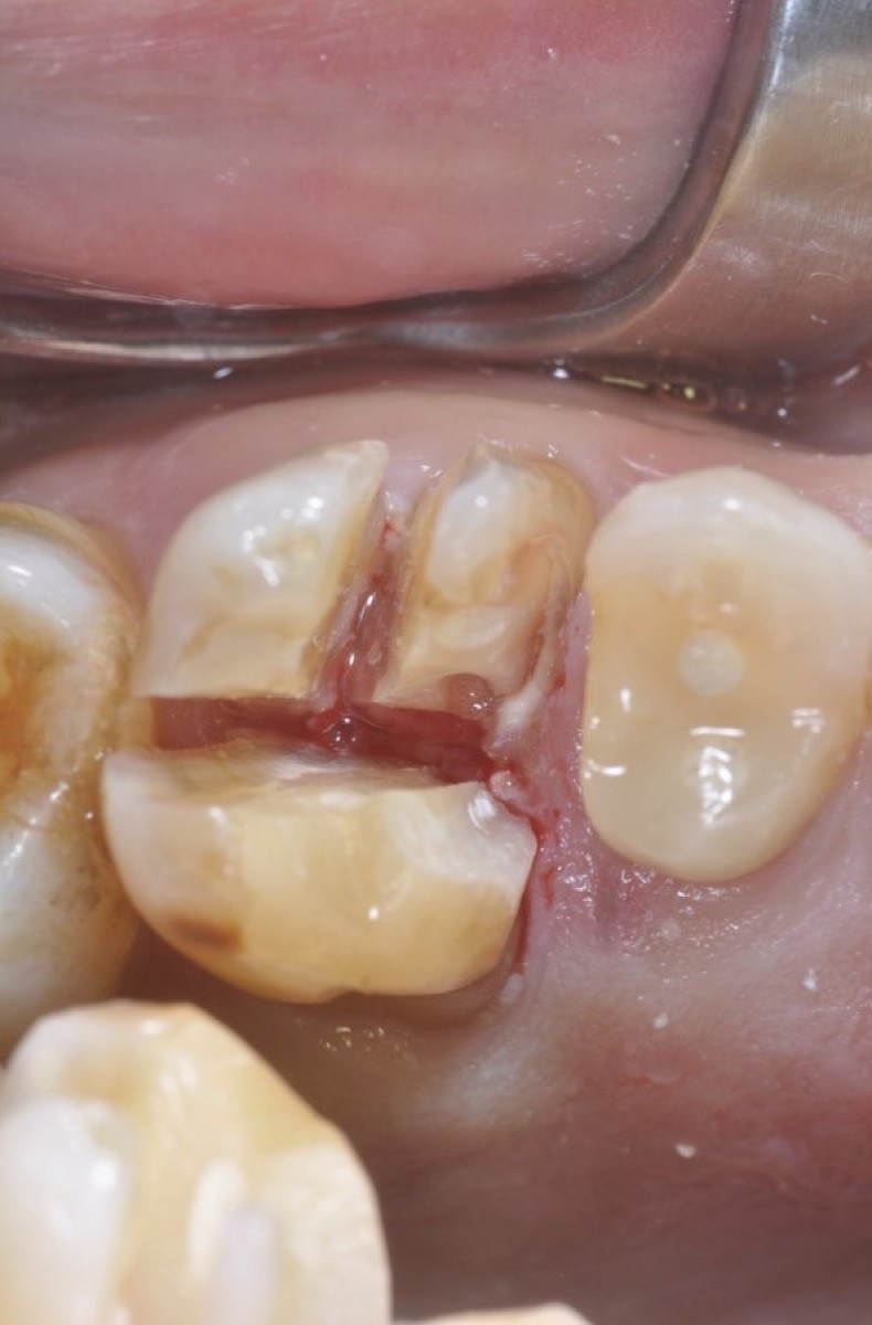 Figure 3: Conservative extraction of the natural alveolus, in which the crown is divided into three parts in order to maintain the residual bone anatomy and the interradicular septum