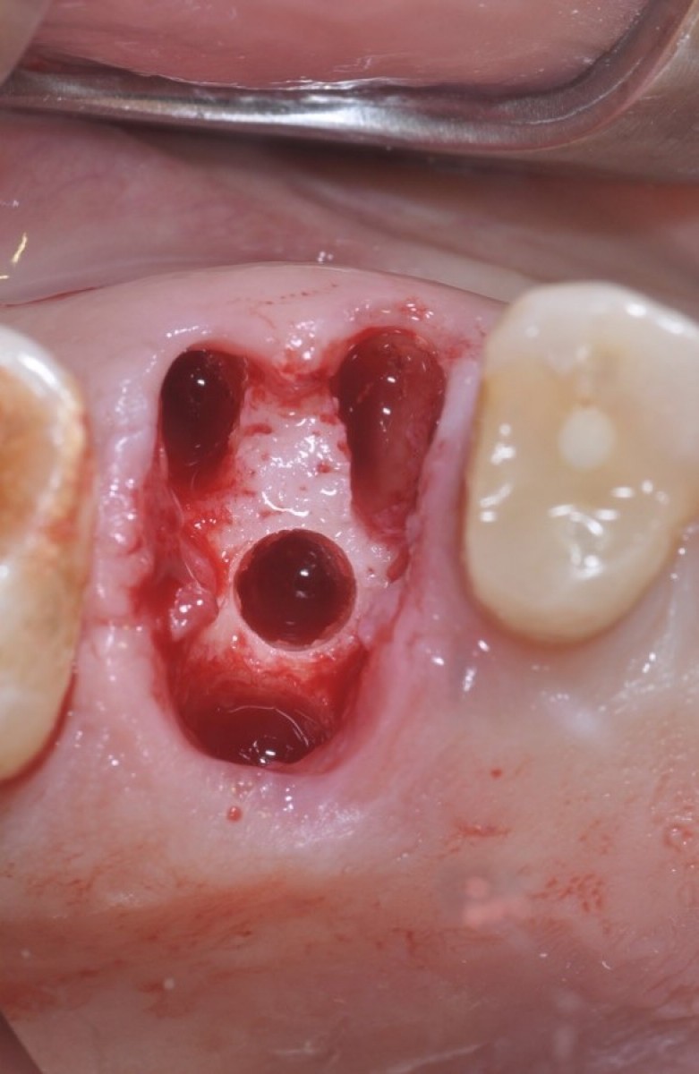 Figure 5: The interradicular septum is prepared with burs to make a sinus lift