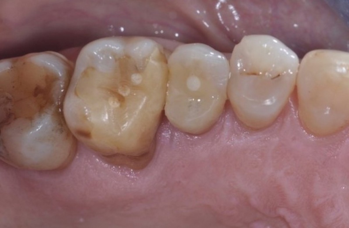 Figure 1: Occlusal view of the elements 1.4, 1.5, 1.6