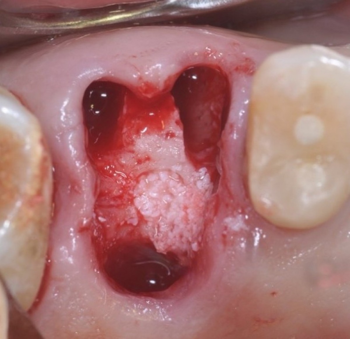 Figure 6: The collagen and then the graft material are inserted inside the septum