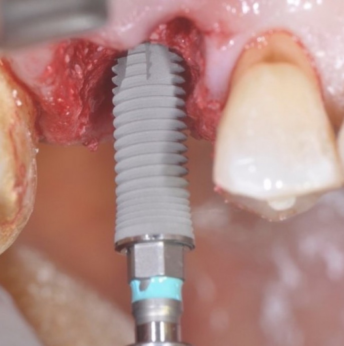 Figure 7: A CSR ø 3.80 mm Wide Neck implant is inserted into the alveolus