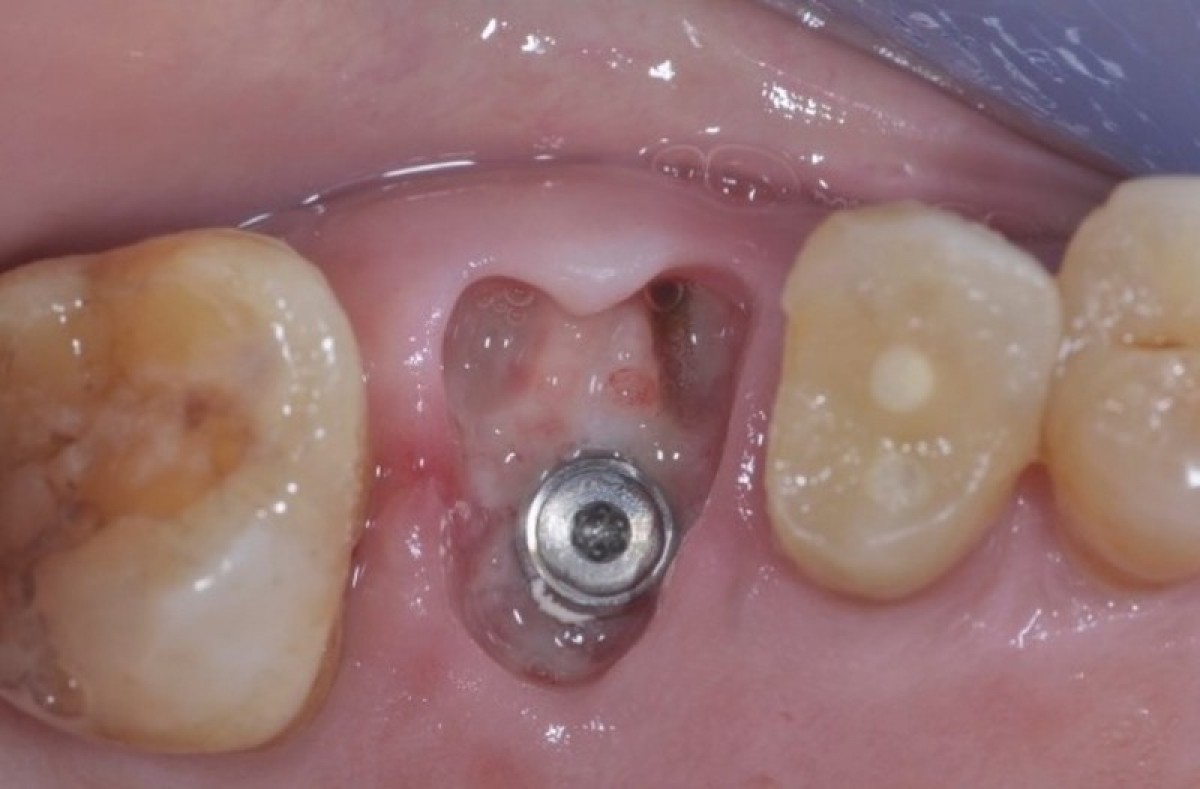 Figure 10: The site is left to heal by second intention. This photo shows the healing of the site after 2 weeks of surgery
