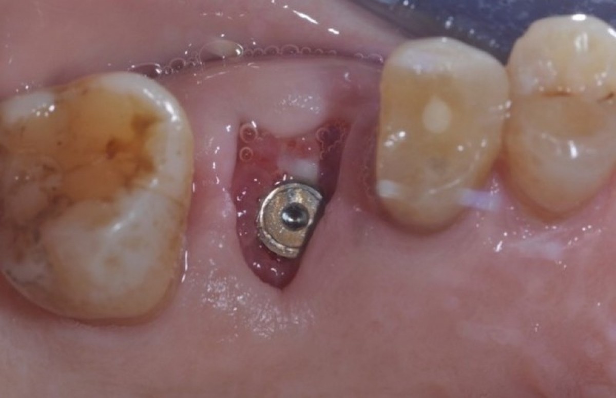 Figure 11: This photo shows the healing of the site after 4 weeks of surgery