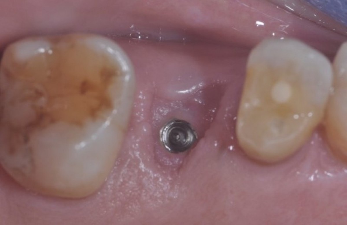 Figure 12: This photo shows the healing of the site after 8 weeks of surgery. It is possible to appreciate the soft tissue volume gain