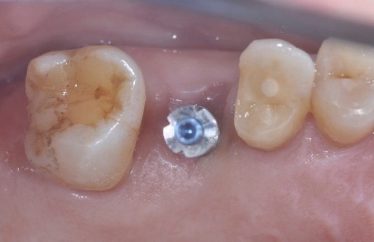 Figure 13: Four months after surgery, the site has completely healed and the impression is taken