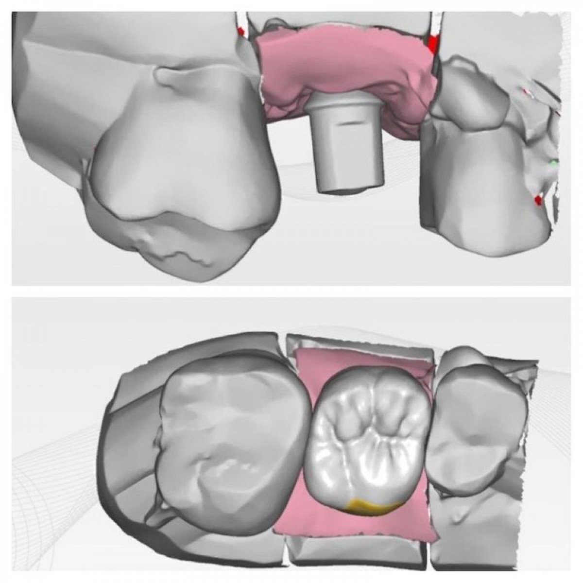 Figure 14: After taking the impression and developing the model, the prosthesis is designed with Exocad software