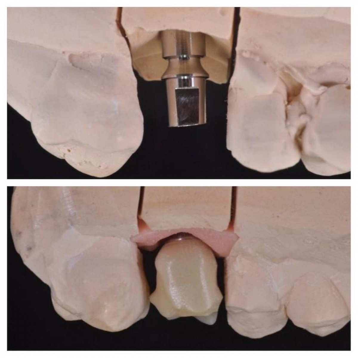 Figure 15: The crown made with CAD/CAM system is tested on a model