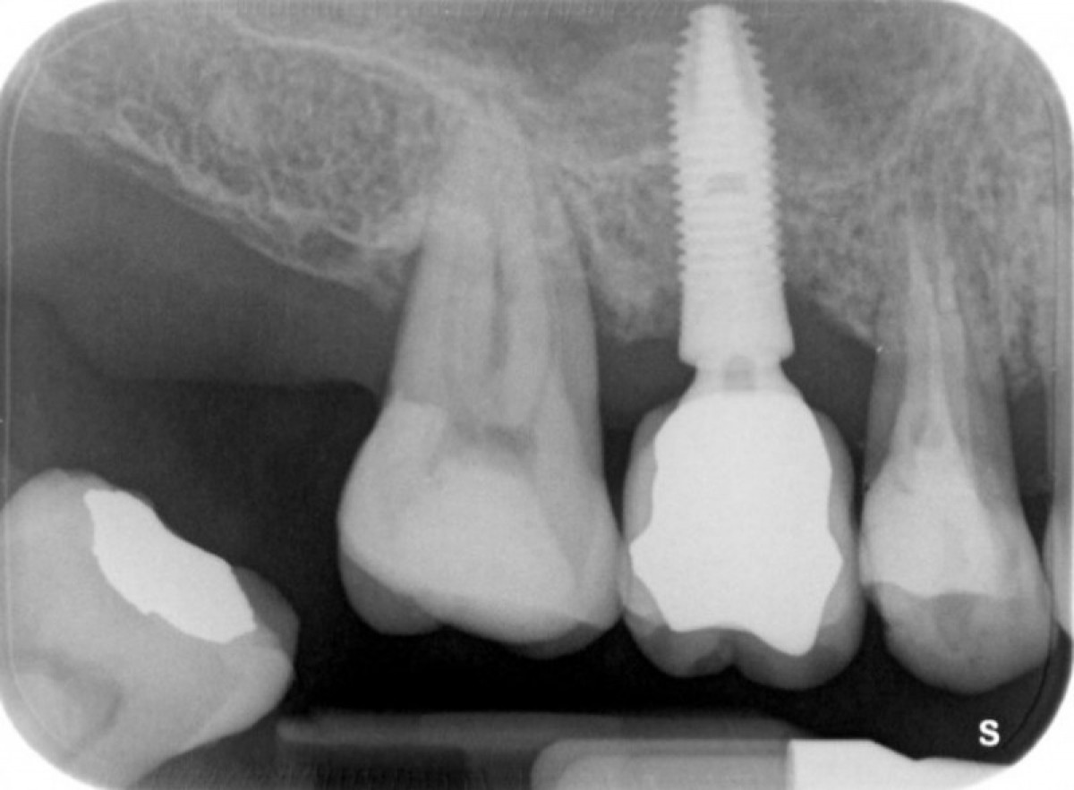 Figure 17: Endoral Rx at the time of crown delivery