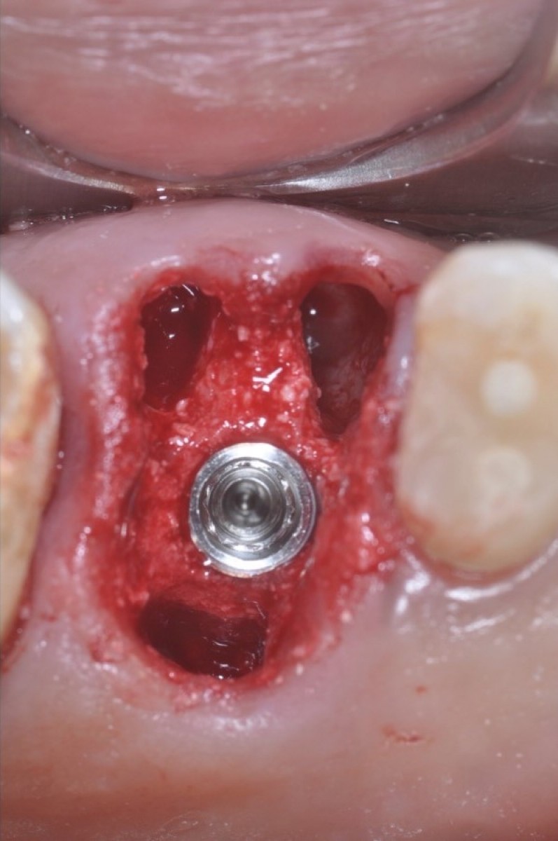 Figure 8: Occlusal view after implant placement (afterwards the site was covered with a periodontal wrap for a week)