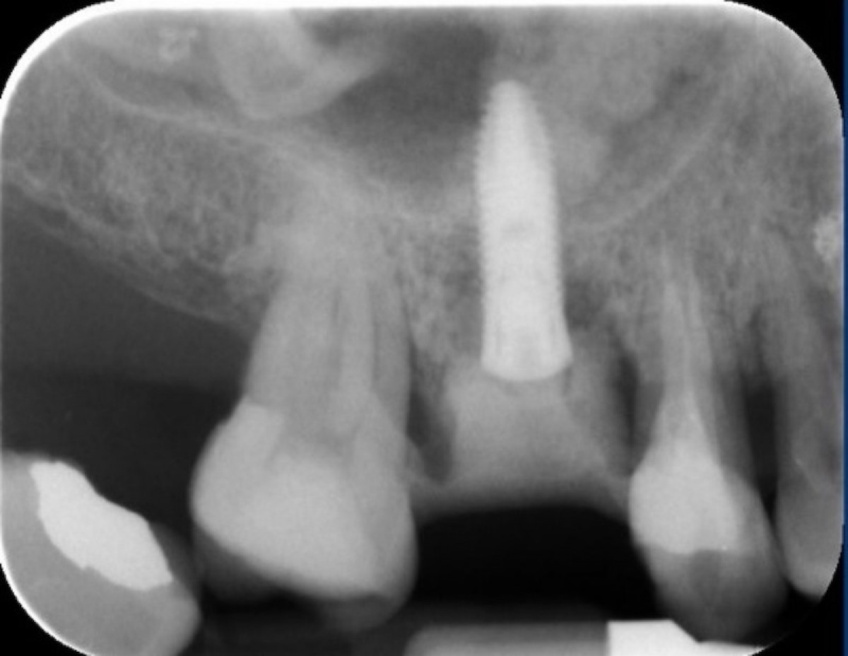 Figure 9: Endoral rx after implant placement