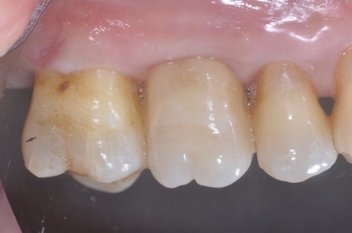 Figure 18: It is possible to notice the growth of the papillae around the crown after two months