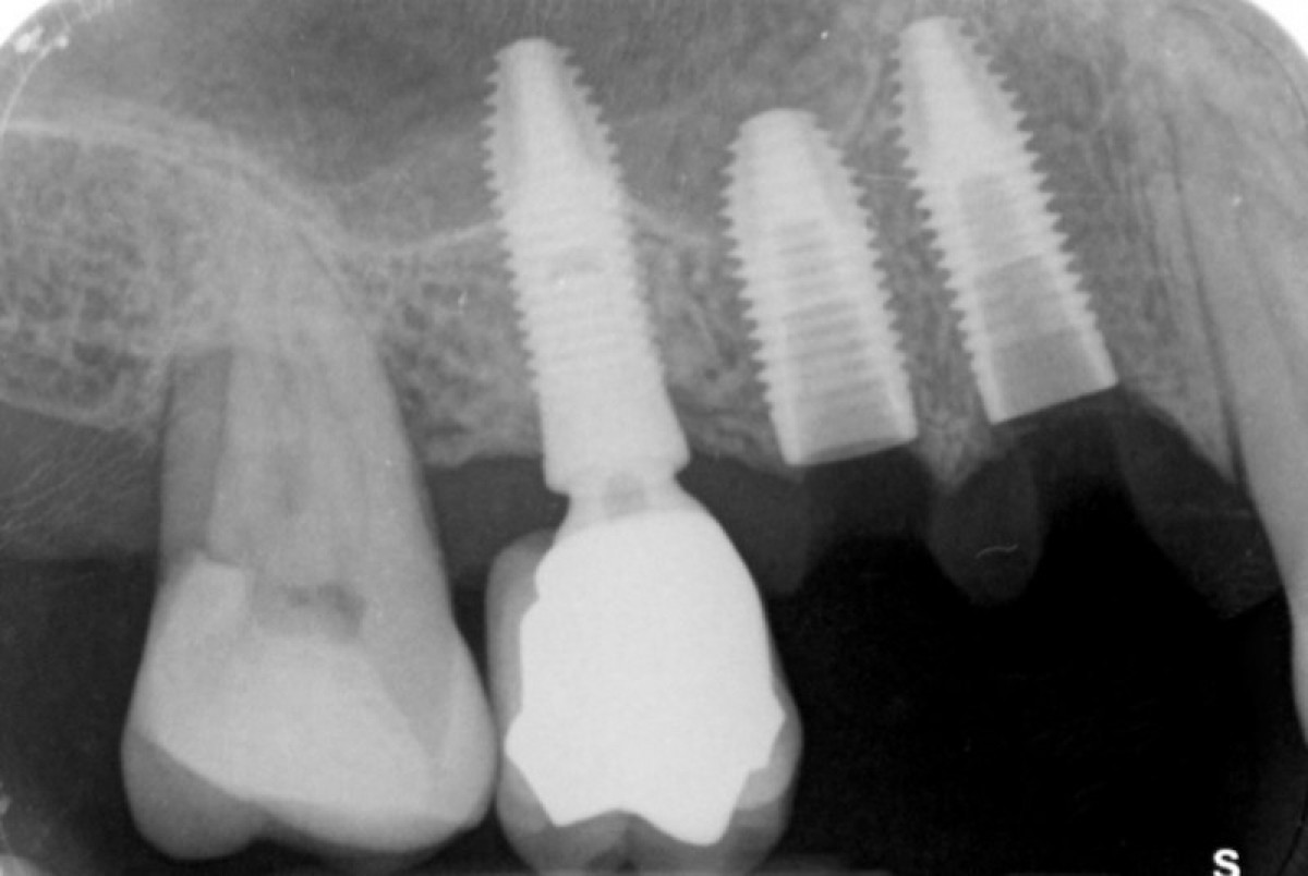 Figure 20: As shown in the Rx, in the second surgical phase both the extraction of the element 14 (a CSR ø 3.80 mm Straight Neck implant is inserted) and the extraction of the element 15 (a mini sinus rise is carried out and a CSR system ø 4.20 Reduced Neck)