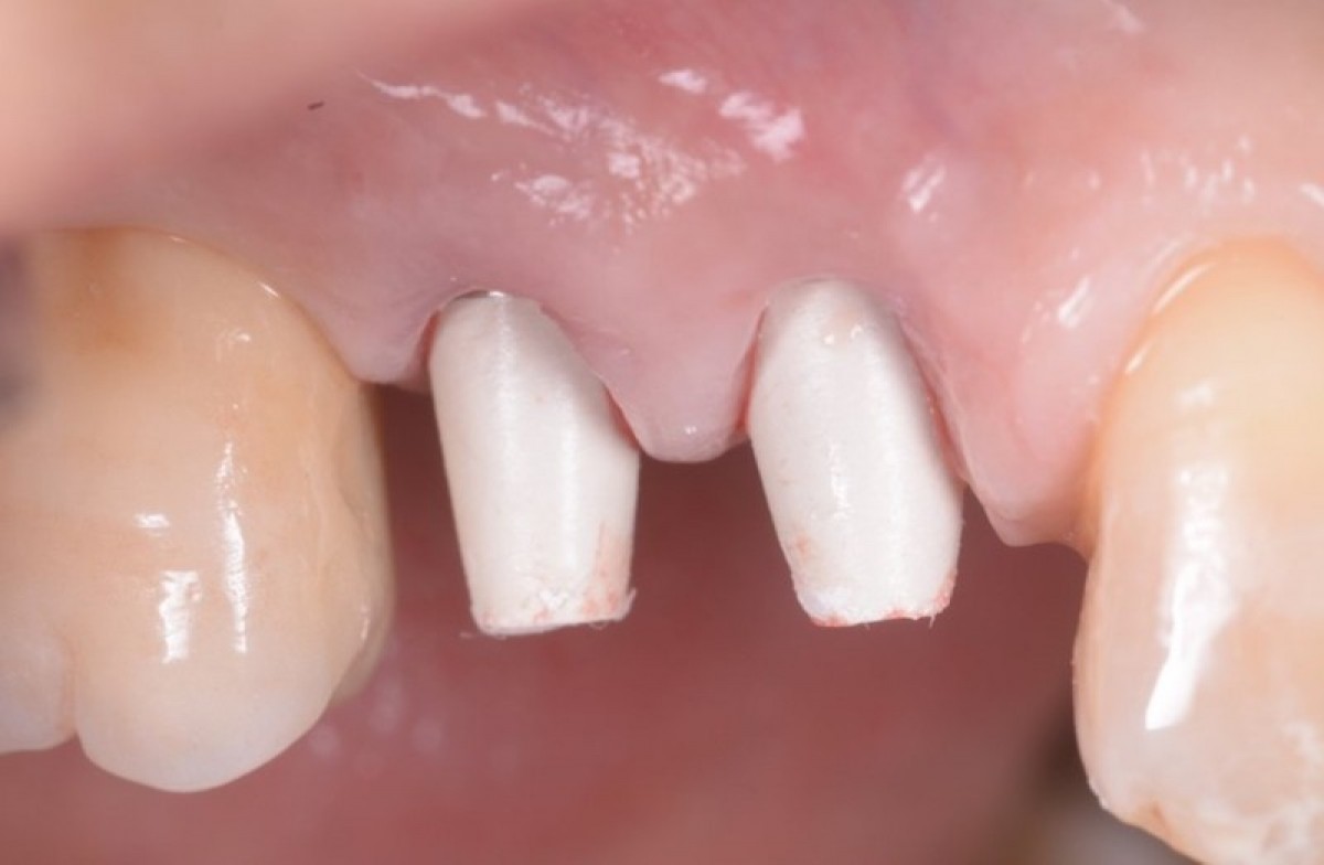 Figure 21: Temporary and polished PEEK temporary posts are screwed to the implants